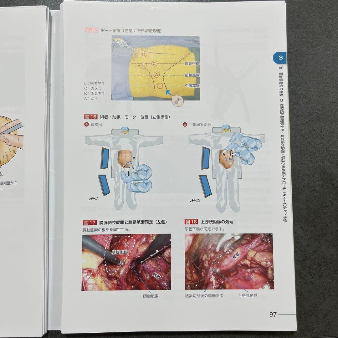 究める 腎・副腎腫瘍に対する腹腔鏡・ロボット支援手術
