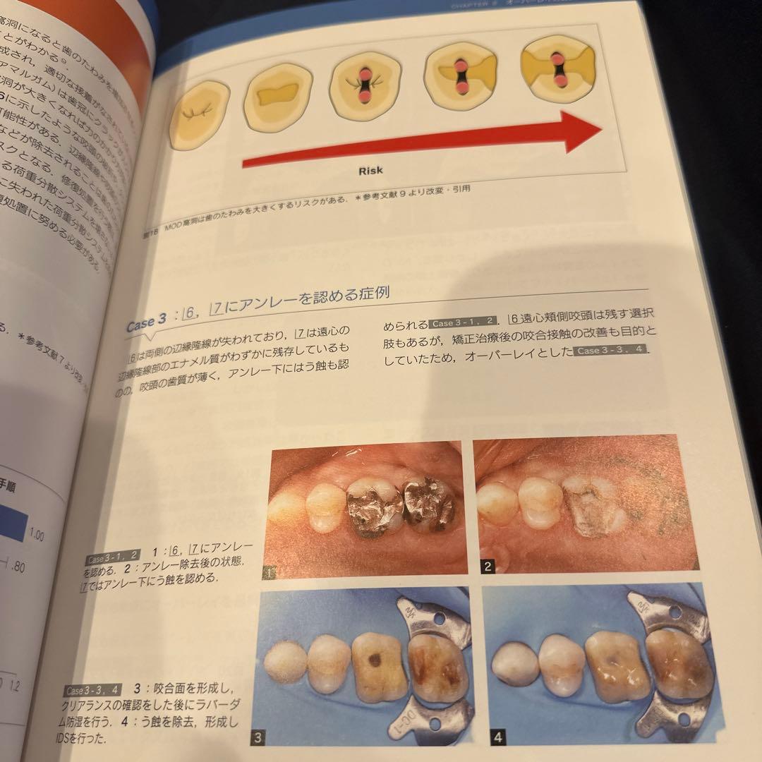 オーバーレイ修復 超入門