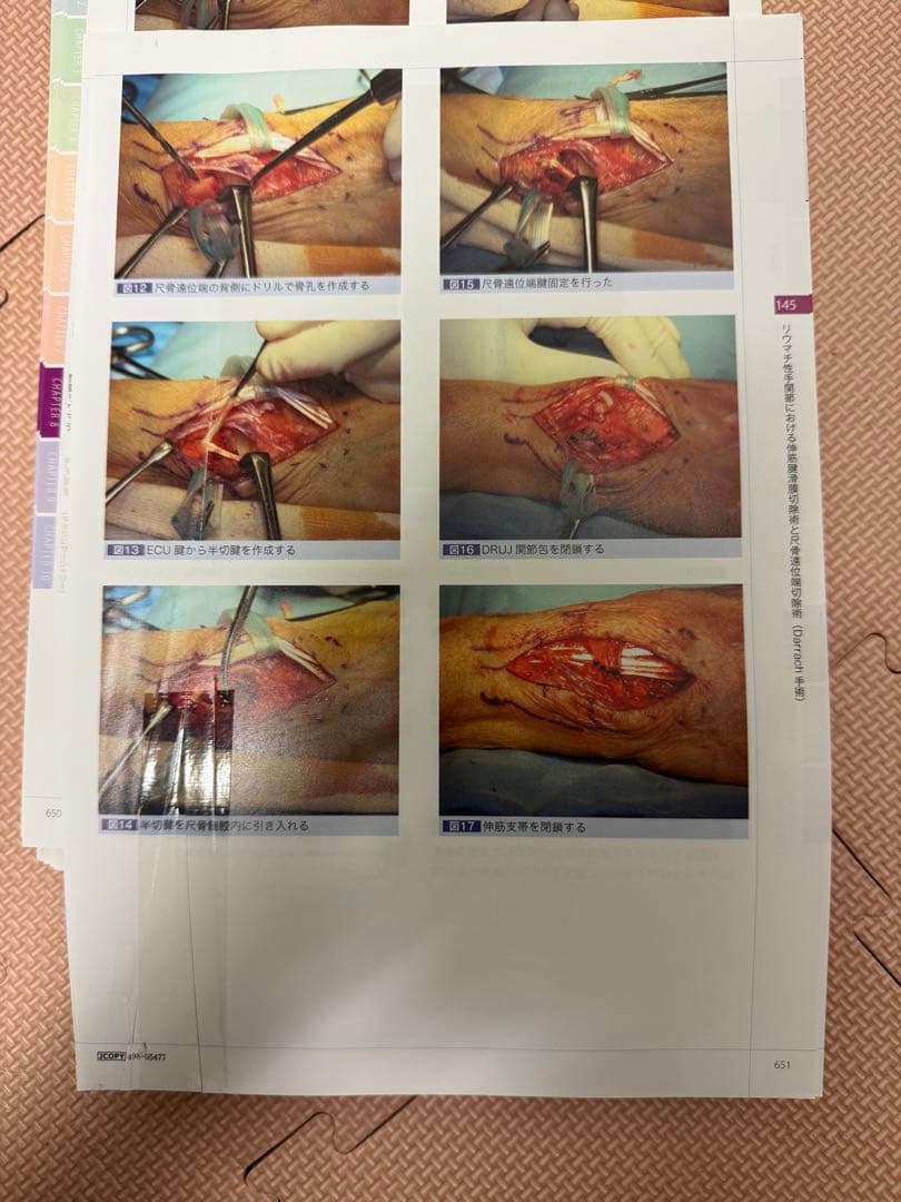 手の外科私のアプローチ