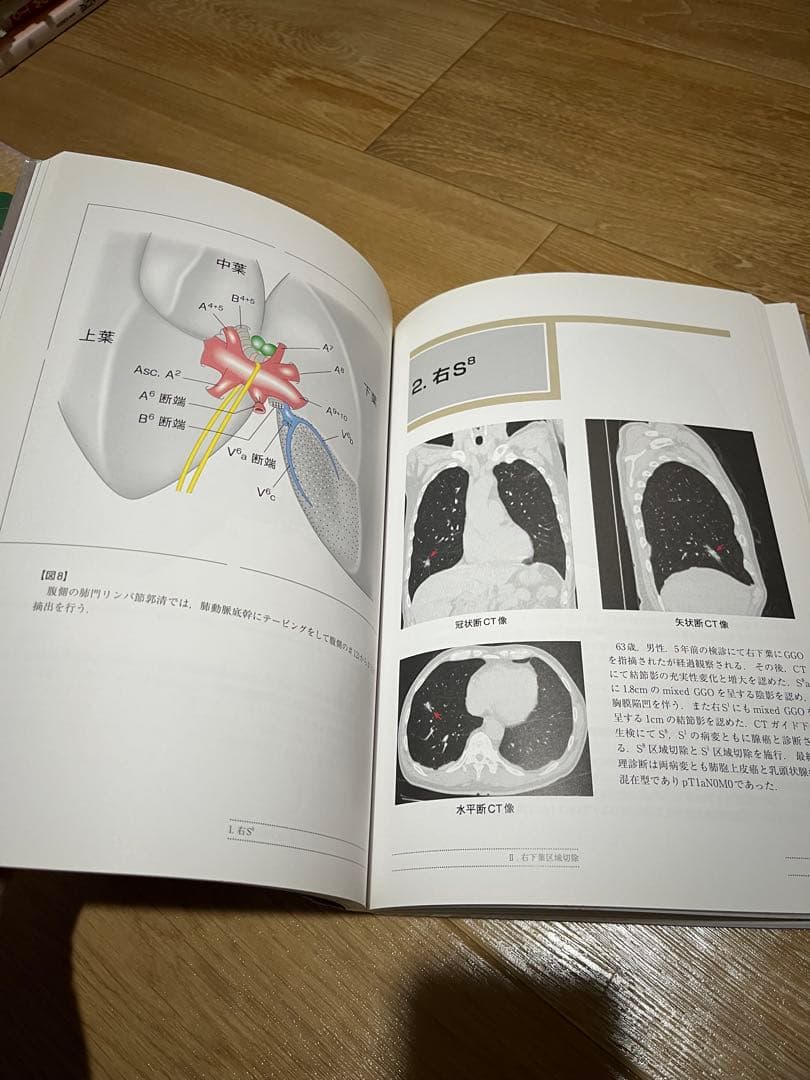 イラストで学ぶ系統的肺区域切除術 区切アトラス - 野守裕明、岡田守人著