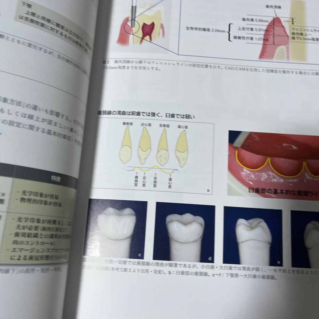デジタル時代の歯冠修復