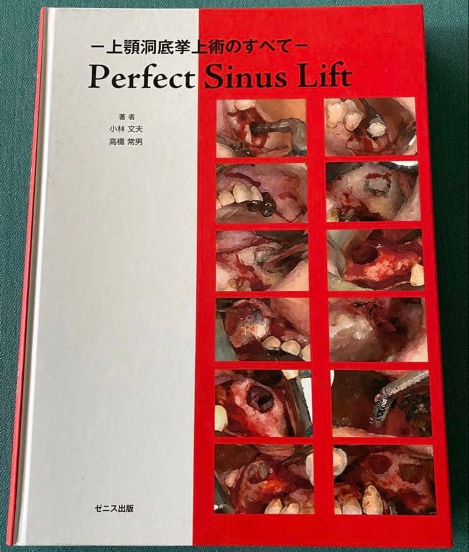 Perfect Sinus Lift - 上顎洞底挙上術のすべて