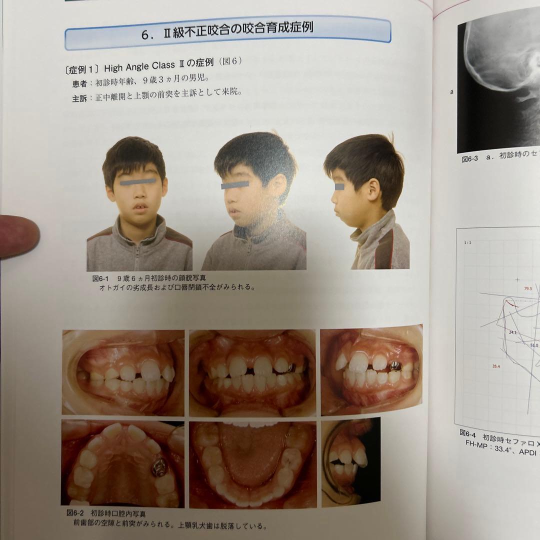 成長・発達期における不正咬合の早期治療